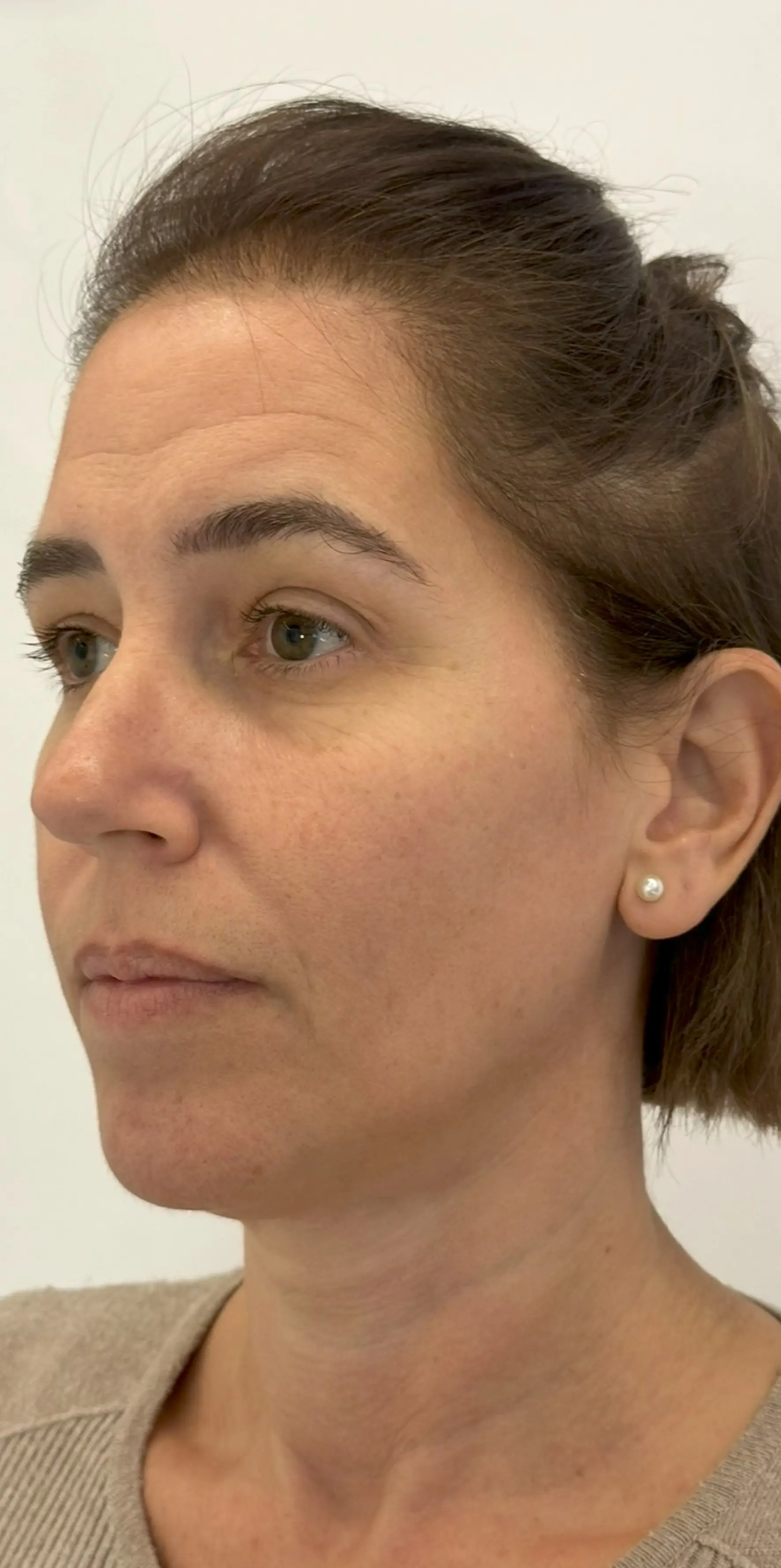 Armonización facial