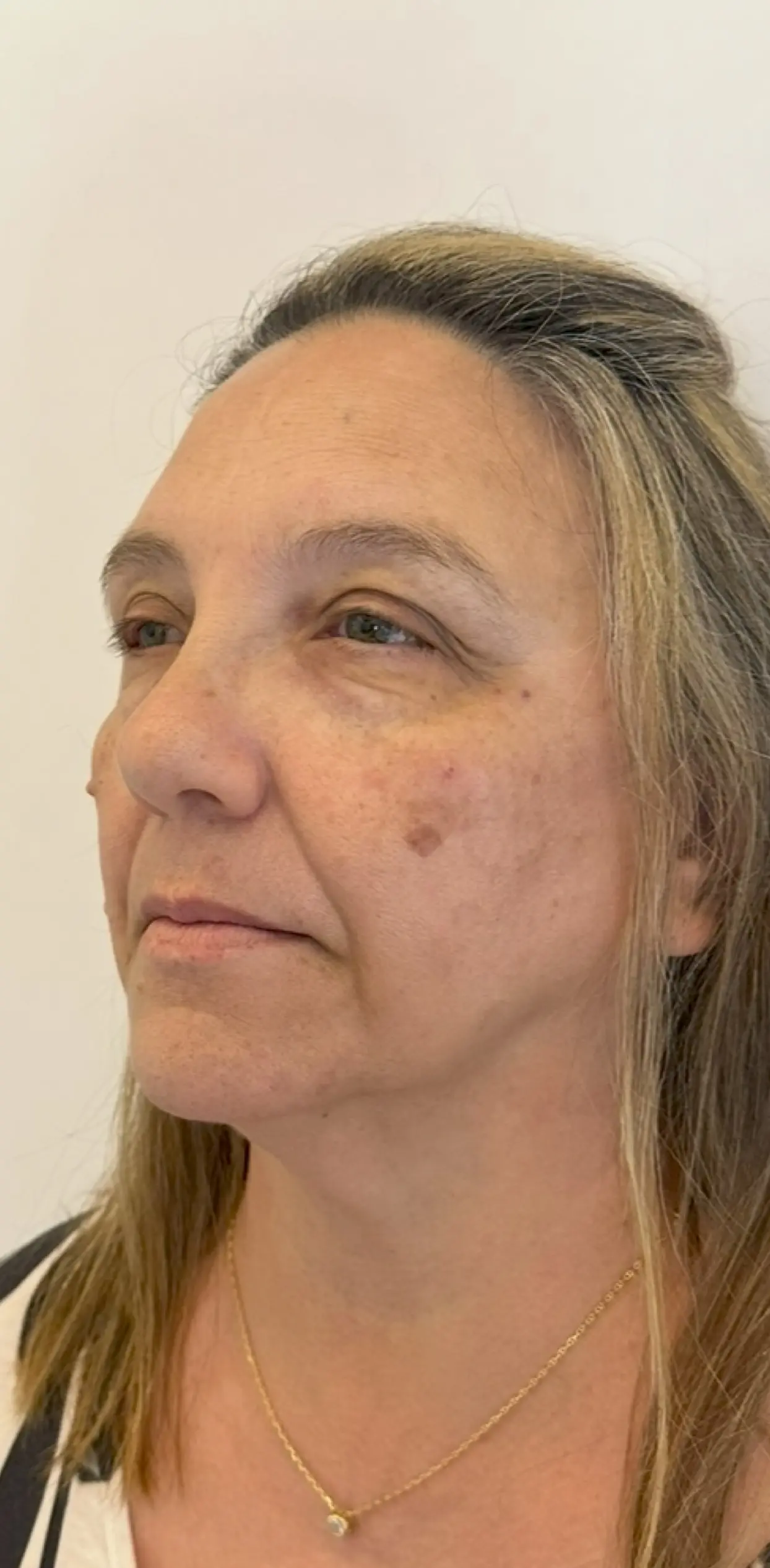 Armonización facial personalizada